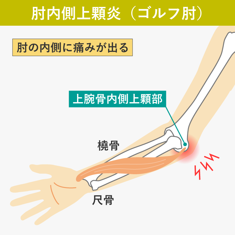 肘内側上顆炎（ゴルフ肘）