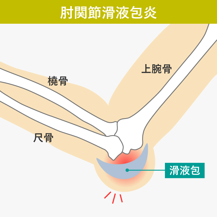 肘関節滑液包炎