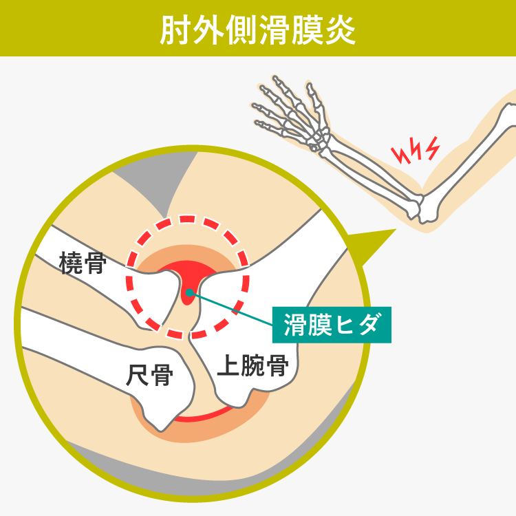 肘外側滑膜炎