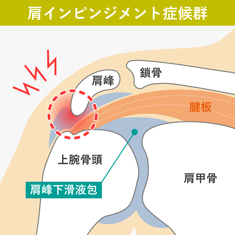 肩インピンジメント症候群