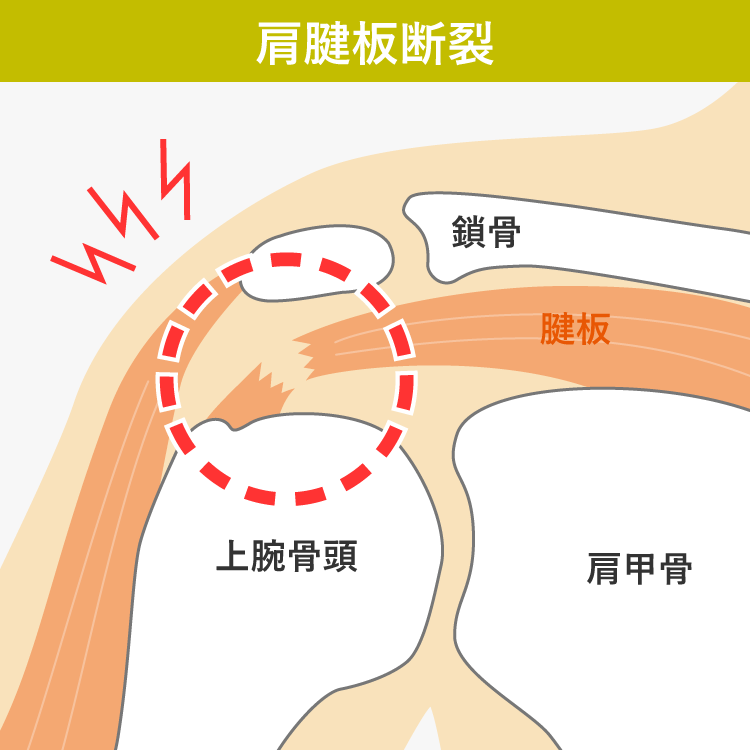 肩腱板断裂