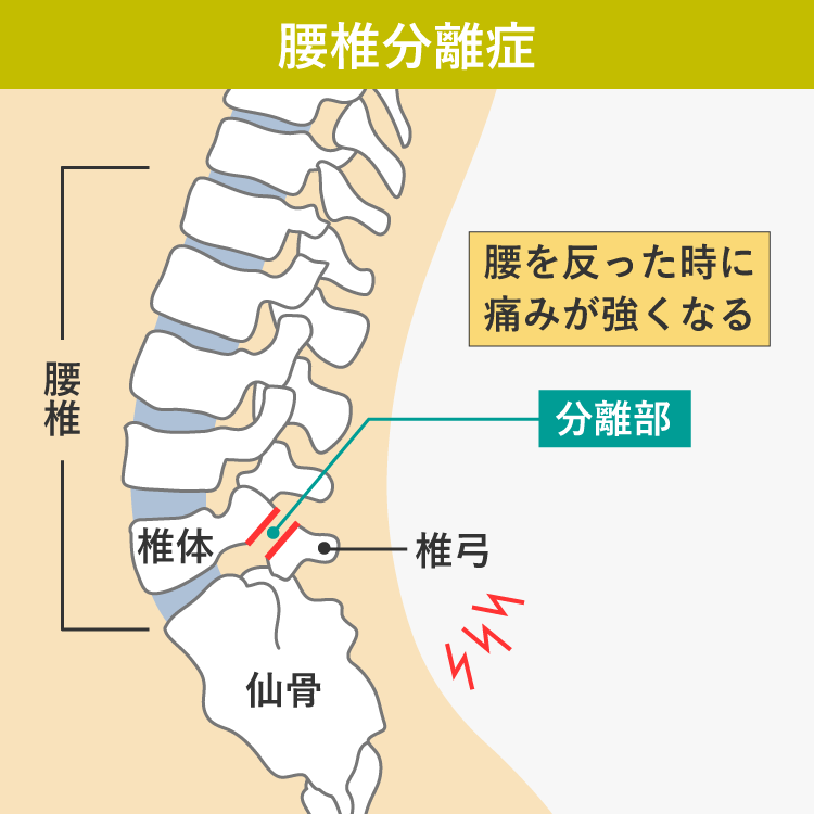 腰椎分離症